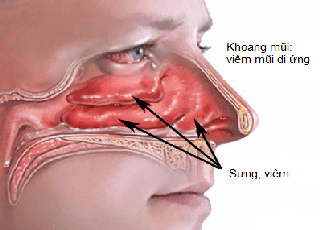 Lưu ý khi dùng kháng histamin chữa viêm mũi dị ứng
